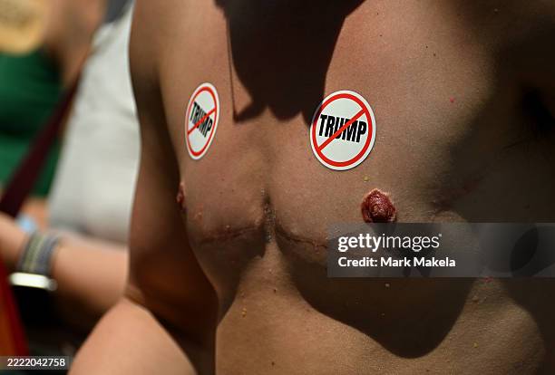 Spectator with "top surgery scars wears anti-Trump stickers during the 2025 Denver Pride Parade on June 29, 2025 in Denver, Colorado. Organizers...