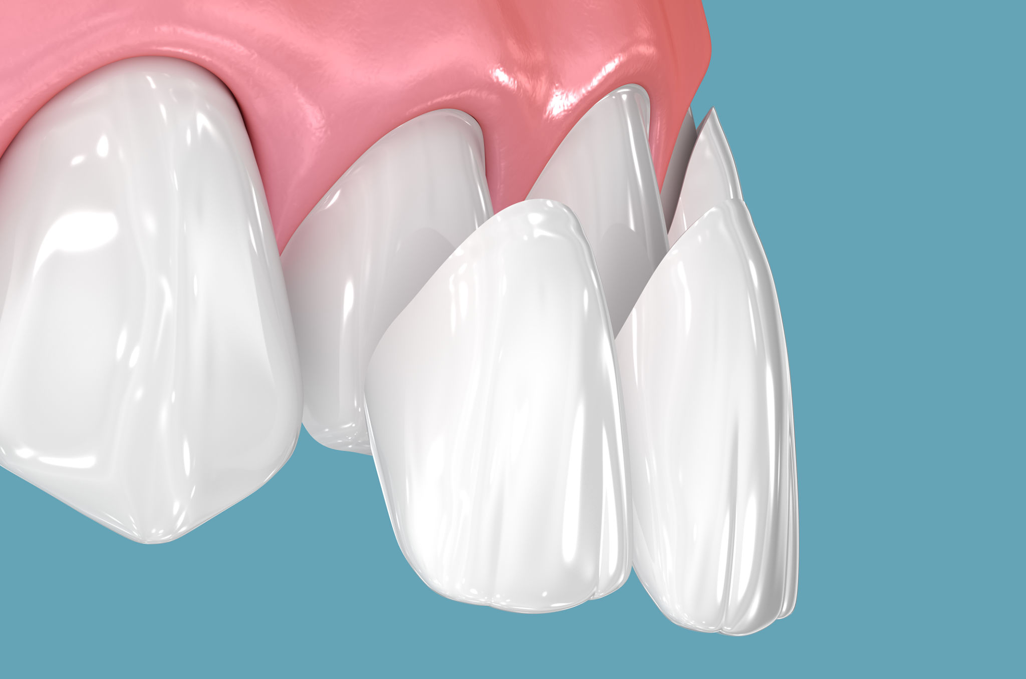 dental veneers