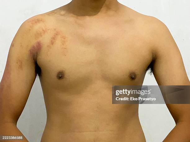 red bruise from tendon massage on the skin surface on the right back and shoulder - bruise stock pictures, royalty-free photos & images
