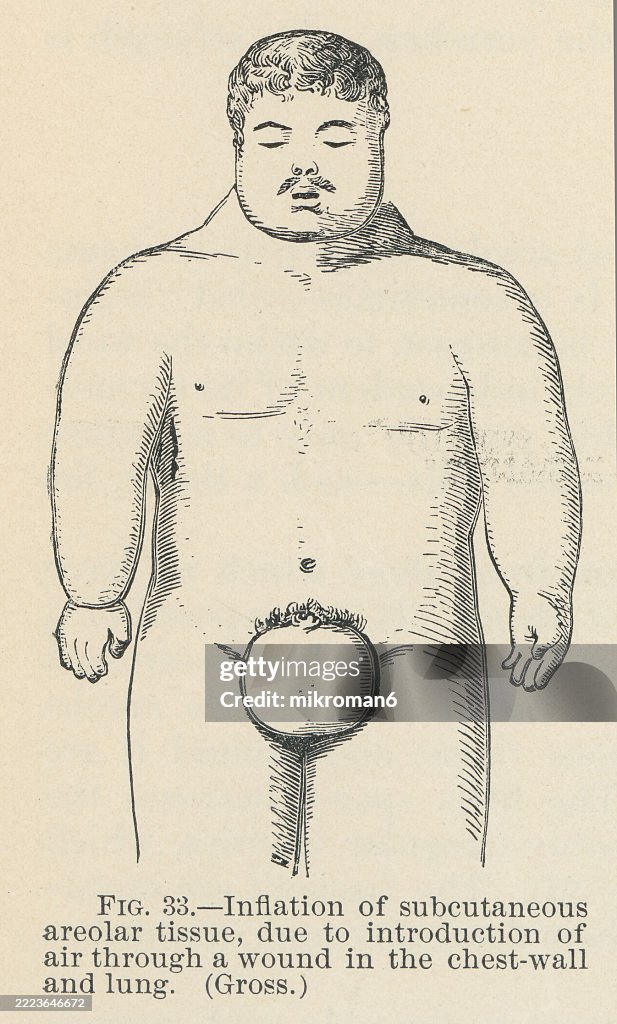 Old engraved illustration of inflation of subcutaneous areolar tissue due to introduction of air through a wound in the chest-wall and lung