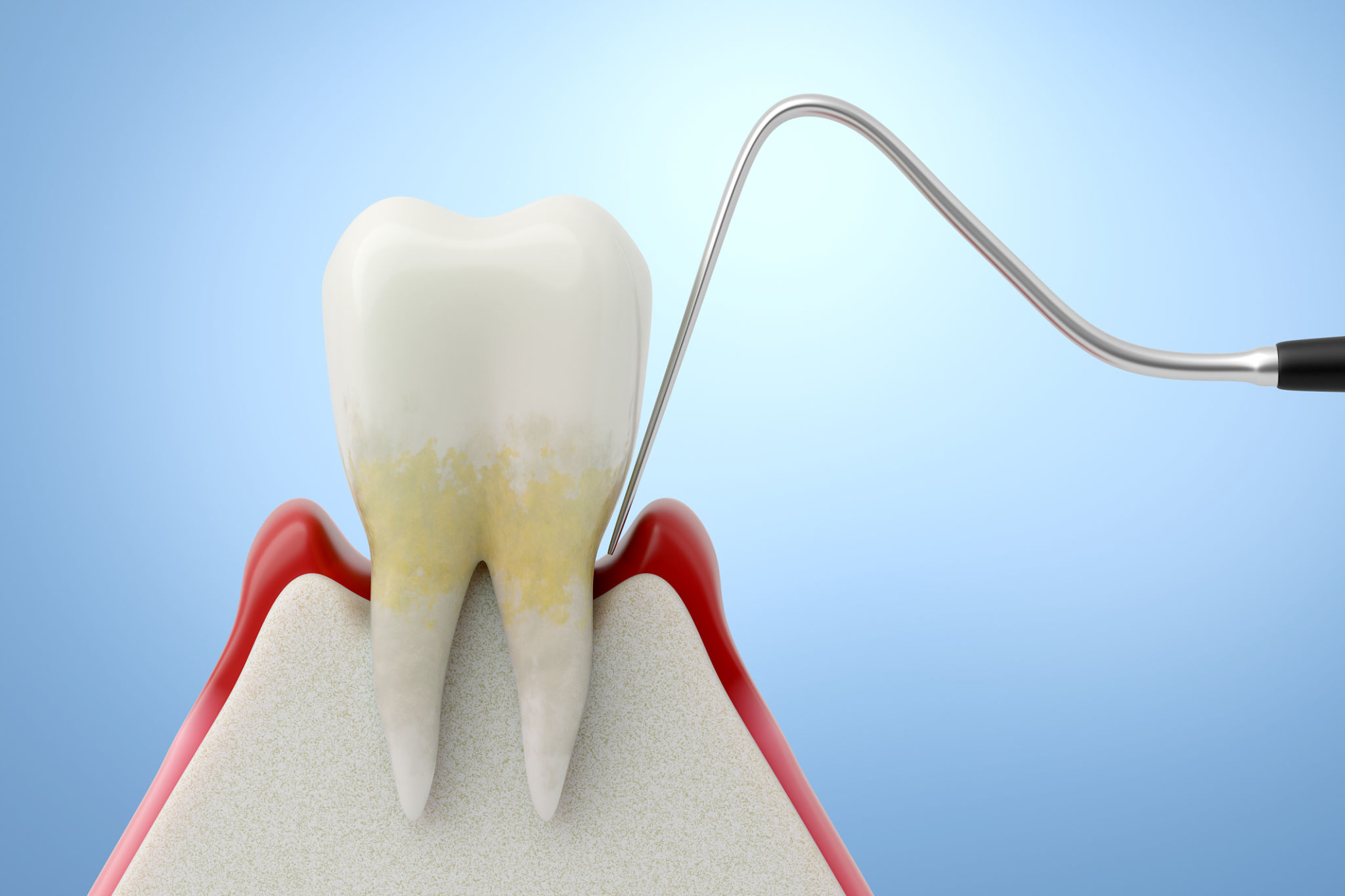 periodontal treatment