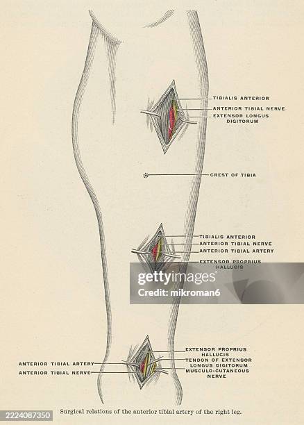 Tibia Ulcer 261 Leg Ulcer Stock Photos, High-Res Pictures, and Images - Getty Images