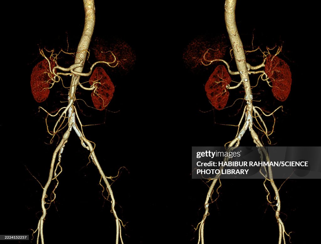 Arterial calcification, 3D CT scan