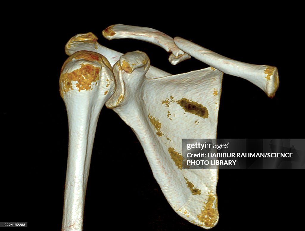 Collar bone fracture, 3D CT scan