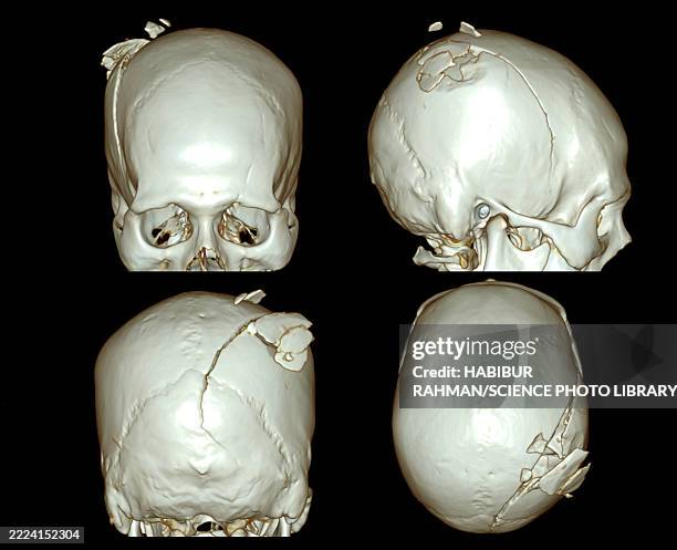Skull Scan 899 Ct Scan Head Stock Photos, High-Res Pictures, and Images - Getty Images