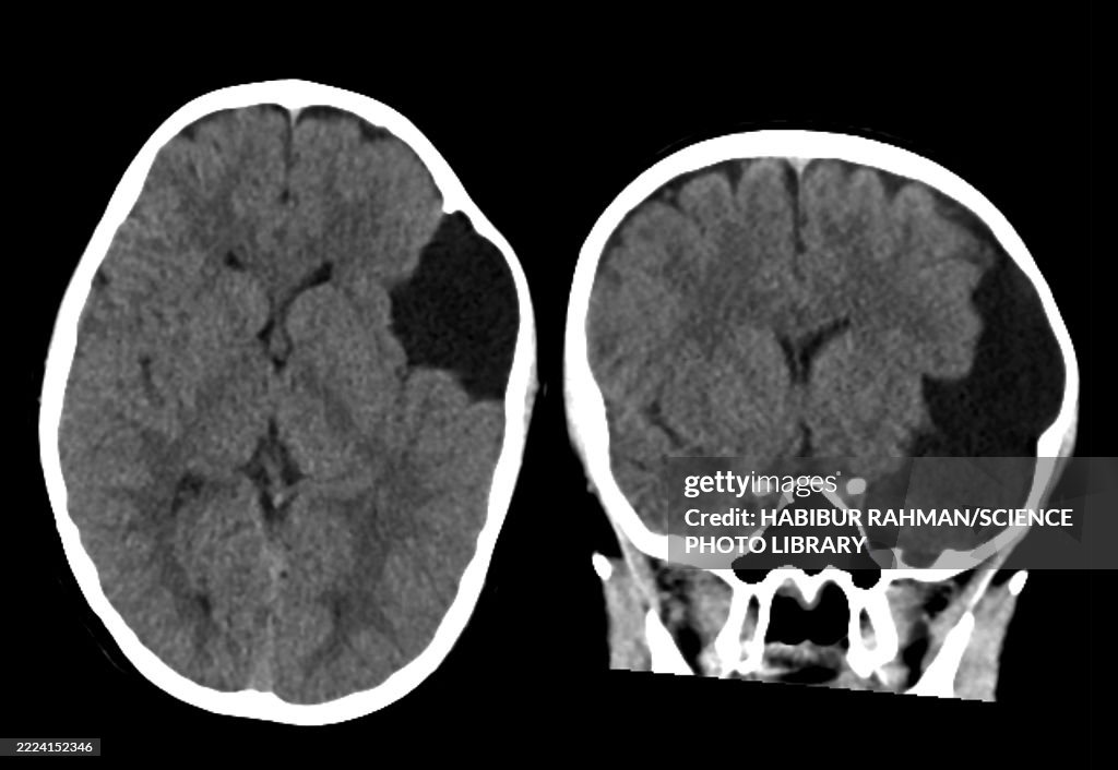 Arachnoid cyst, CT scans