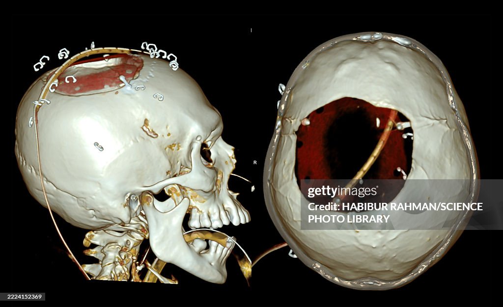 Post-operative skull and brain, 3D CT scans