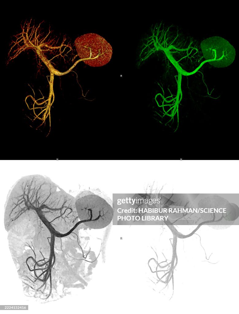 Portal, splenic and mesenteric veins, 3D angiograms