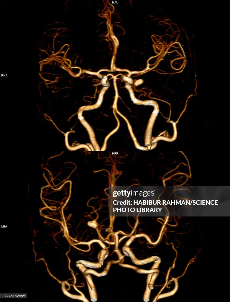Cerebral artery aneurysm, 3D angiograms