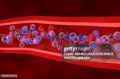 Diffuse large B-cell lymphoma, illustration Diffuse large B-cell lymphoma, illustration