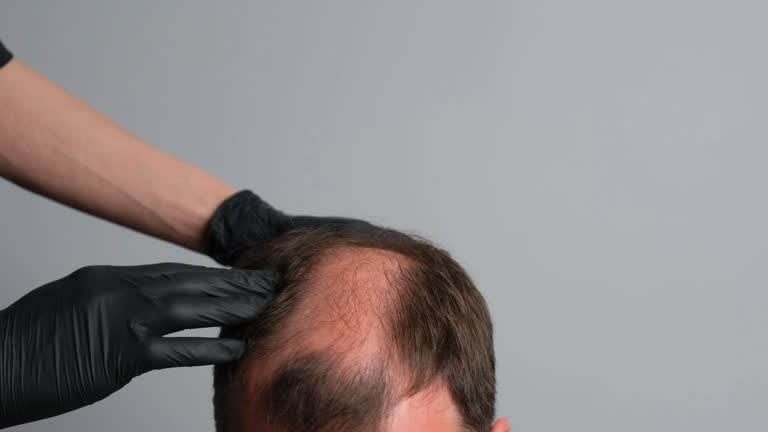 https://media.gettyimages.com/id/2225064999/video/a-close-up-of-a-mans-head-with-visible-hair-loss-and-thinning-on-the-crown-as-a-person.jpg?b=1&s=640x640&k=20&c=uZonjrvai4fVOcAbdJ8I7tsJ_F4Zrbjr-Z-K8Eaj37w=