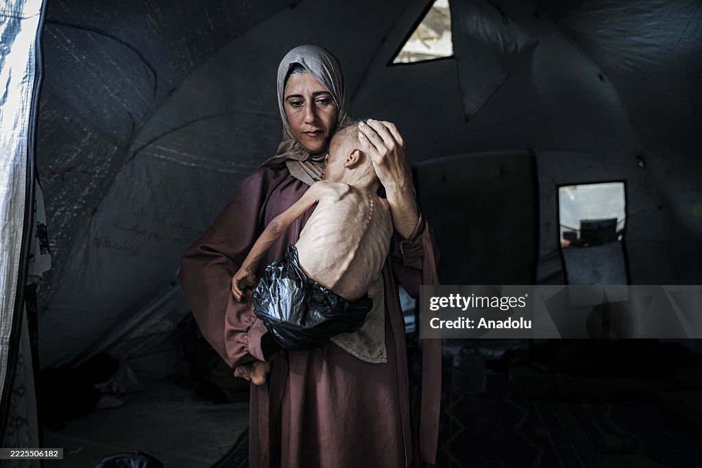 Malnourished toddler in Gaza fights for life amid ongoing Israeli attacks