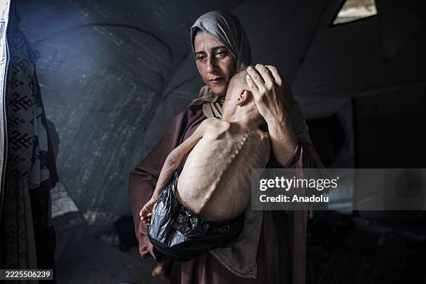 Muhammad Zakariya Ayyoub al-Matouq, a 1.5-year-old child in Gaza City, Gaza, faces life-threatening malnutrition as the humanitarian situation...