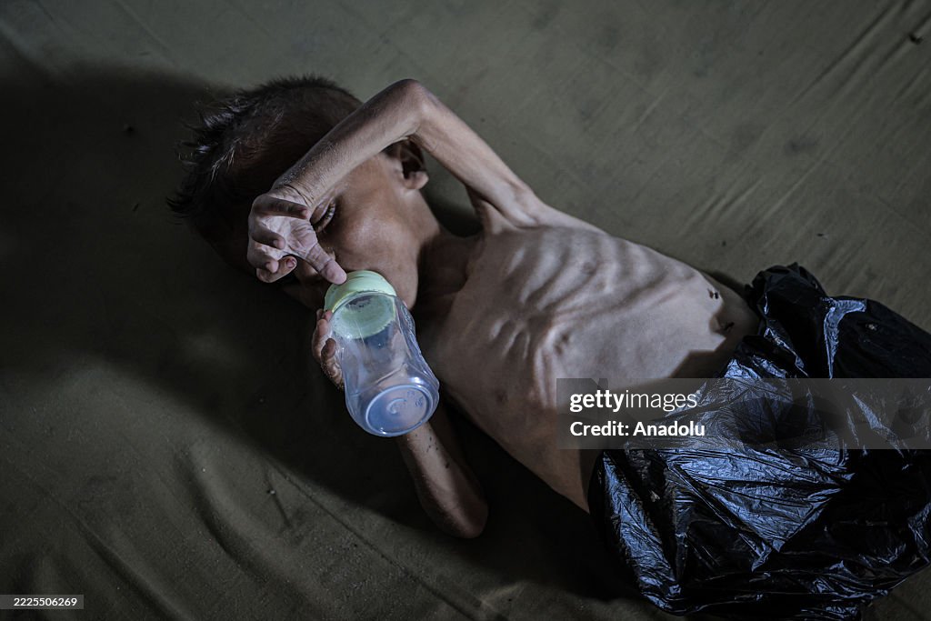 Malnourished toddler in Gaza fights for life amid ongoing Israeli attacks