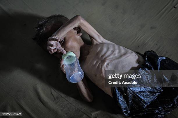 Malnourished toddler in Gaza fights for life amid ongoing Israeli..., News Photo