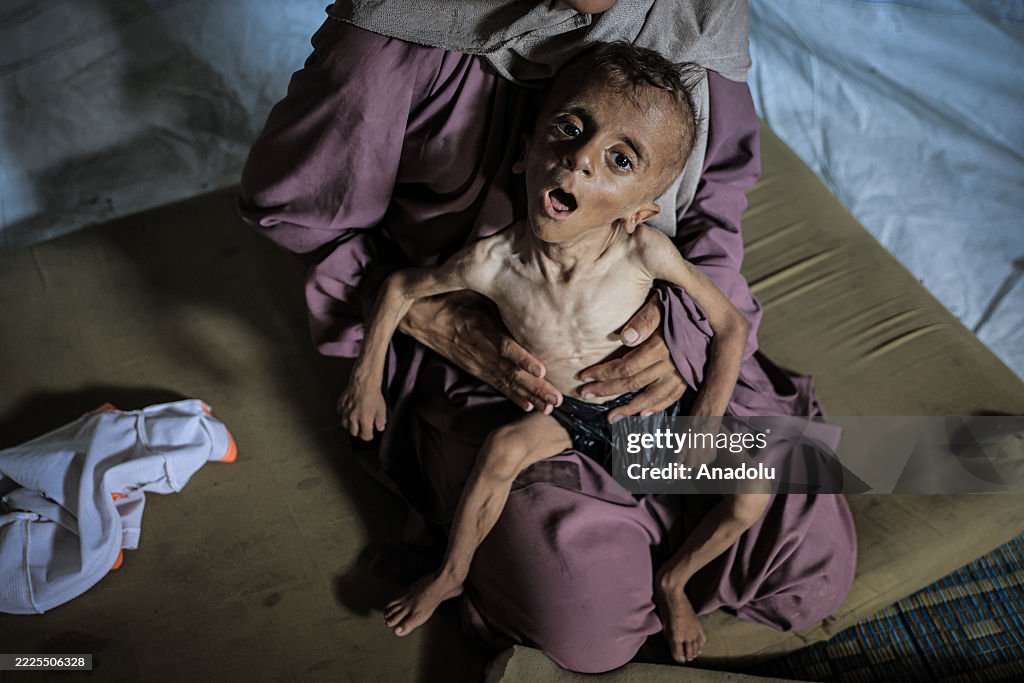 Malnourished toddler in Gaza fights for life amid ongoing Israeli attacks