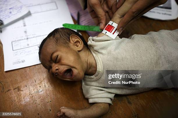 Malnutrition In Gaza Amid Hamas-Israel Conflict, News Photo