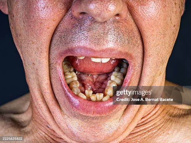 adult man with his mouth open, with deformed and dirty teeth in poor condition. - stained teeth stock pictures, royalty-free photos & images