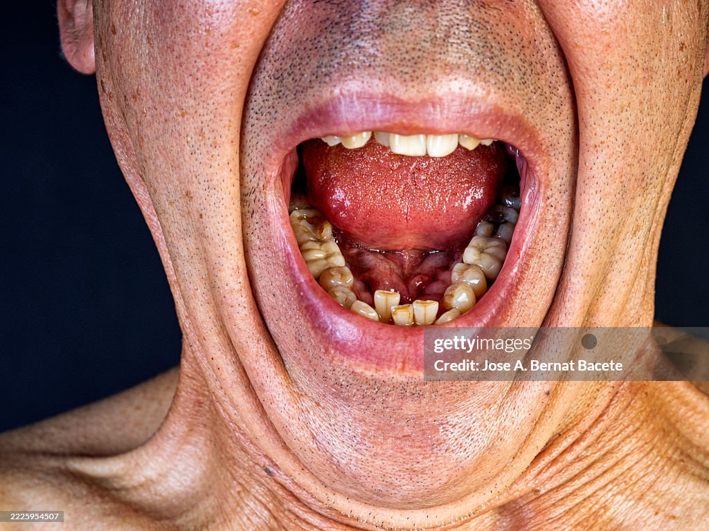 Adult man with his mouth open, with deformed and dirty teeth in poor condition.
