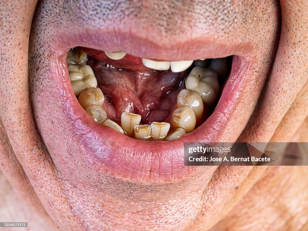 Adult male with deformed teeth of white race.