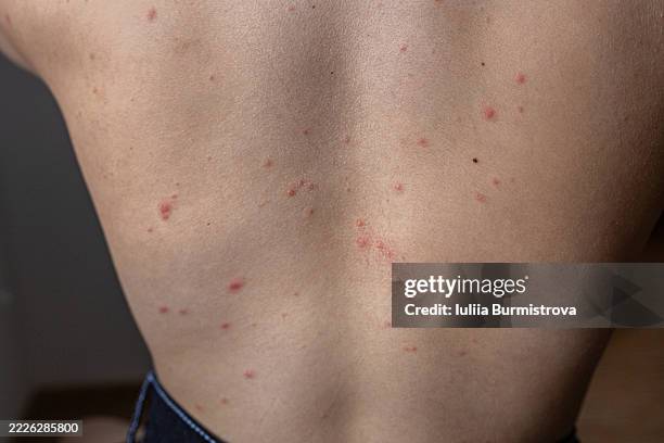Punctate Red Rash Back 71 Itchy Red Skin Stock Photos, High-Res Pictures, and Images - Getty ...
