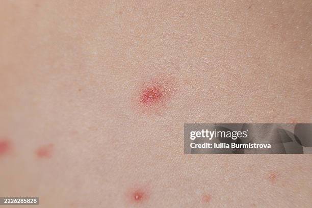 close-up image of red irritated skin with pimples or acne bumps - hyperpigmentation stockfoto's en -beelden