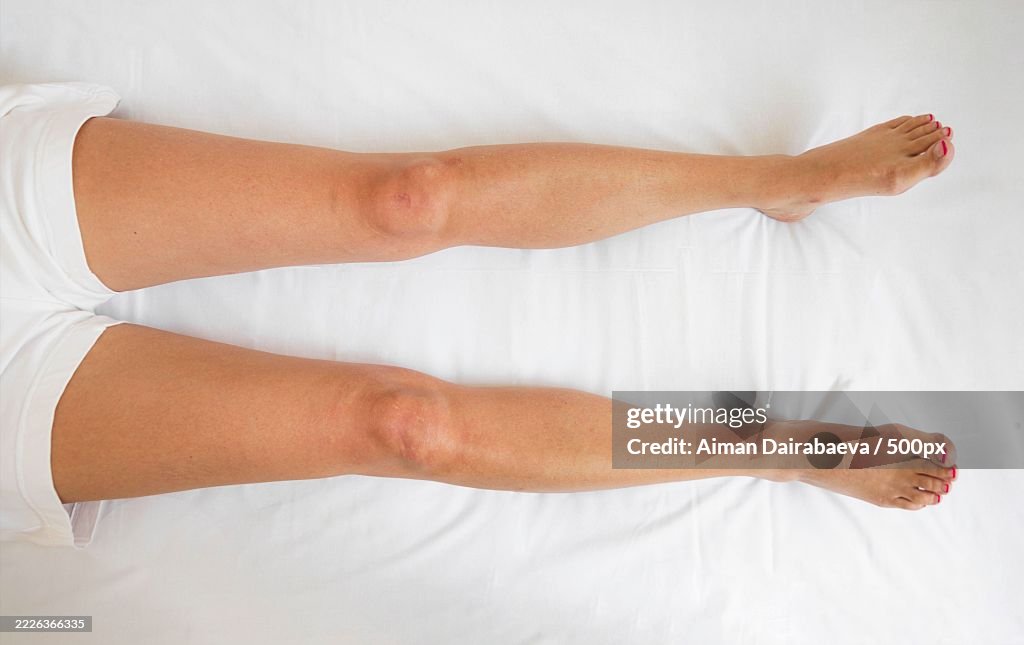 Closeup of woman legs lying flat on white bed in bright medical setting,Swelling,Concept of