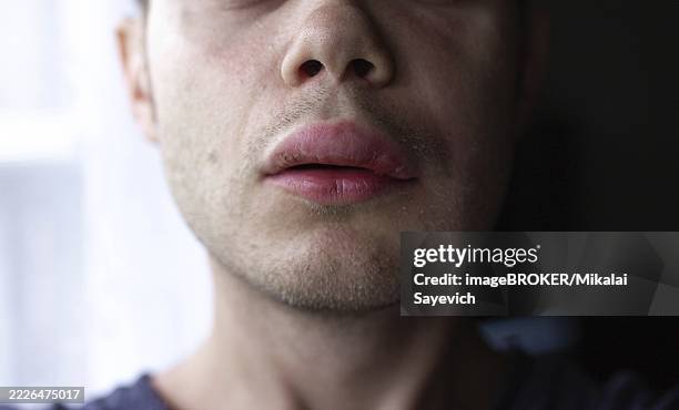 close-up of facial features with lips showing swelling in natural light - swollen stock pictures, royalty-free photos & images