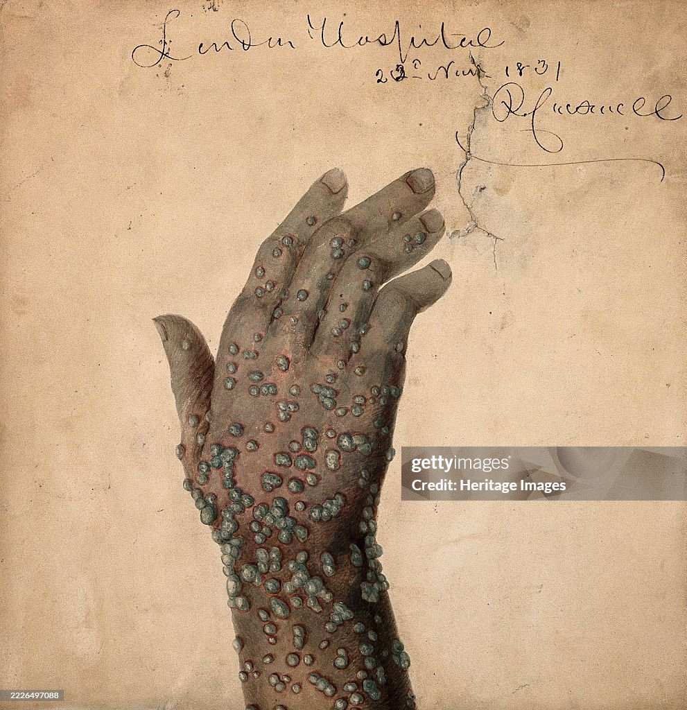 Pustular Striation Rash Rash of pustules on the hand of a patient, probably suffering from ...