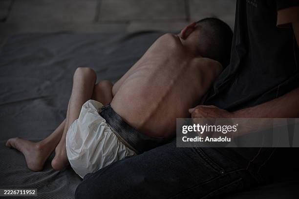 Six-year-old Malik Nidal Saad suffers from severe malnutrition in a tent in western Gaza, where he took shelter with his family after fleeing Beit...