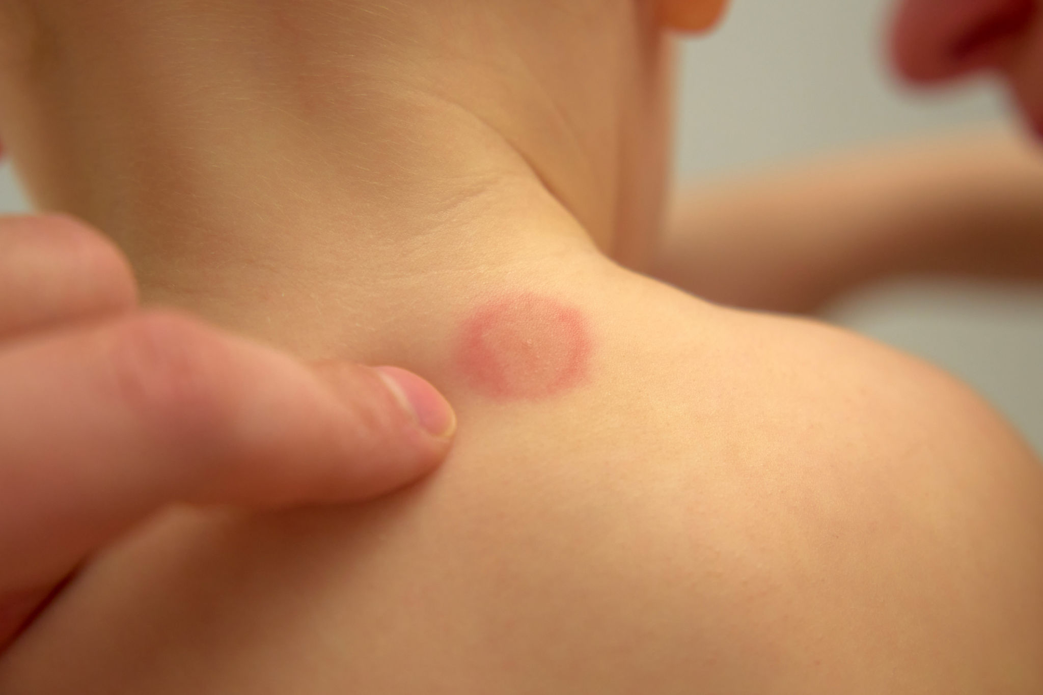 skin redness