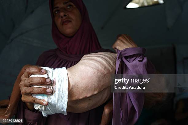 Palestinian woman holds her severely malnourished 1.5-year-old son, Muhammad Zakariya Ayyoub al-Matouq, inside a tent shelter in Deirl Al-Balah, Gaza...