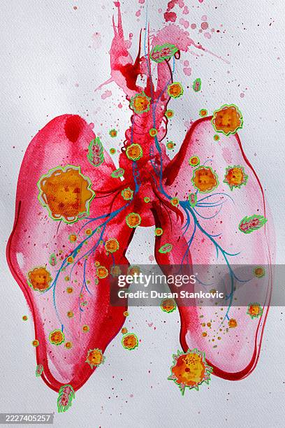 ilustrações de stock, clip art, desenhos animados e ícones de lung infection - organismo acidófilo
