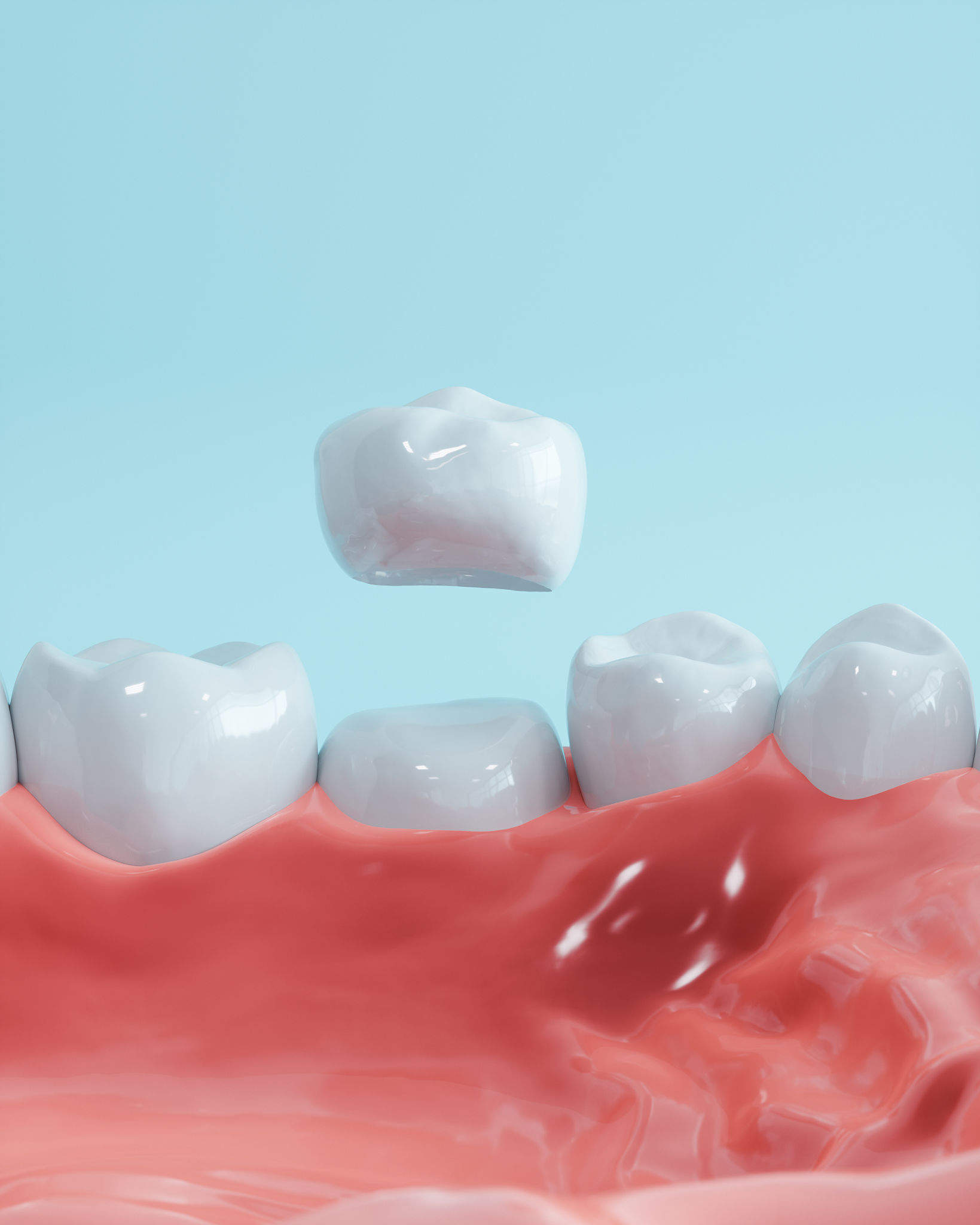 dental crowns