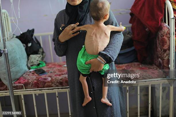 Children of various ages suffering from malnutrition are being treated with limited resources due to shortages of baby formula and medicine at...