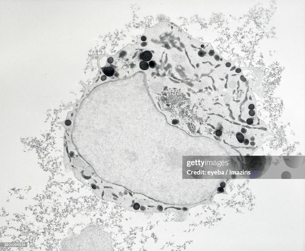 Oxidative DAB staining of megakaryocyte carcinoma of the bone marrow