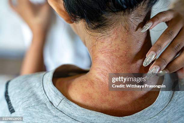 Grey Neck Rash 78 Neck Rash Stock Photos, High-Res Pictures, and Images - Getty Images