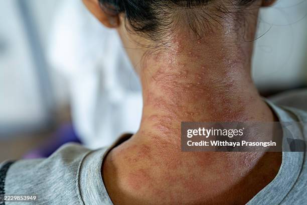 Ntkc Rashed Rash On Neck Atopic Dermatitis Image