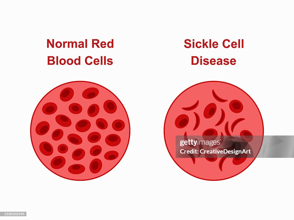 Normal Red Cell Comparison Of Normal Red Blood Cells And Sickleshaped Cells High-Res ...