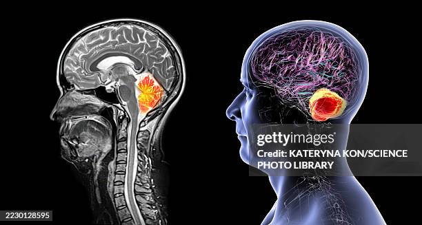 cerebellum mri scan, illustration - neuroimaging stock illustrations