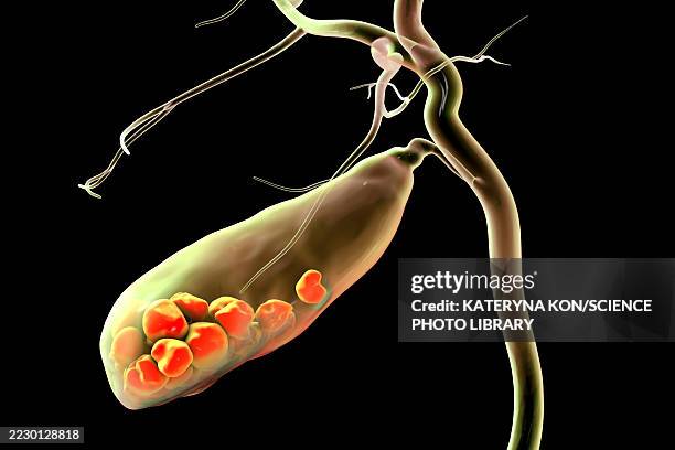 gallbladder with stones, illustration - gall bladder stock illustrations