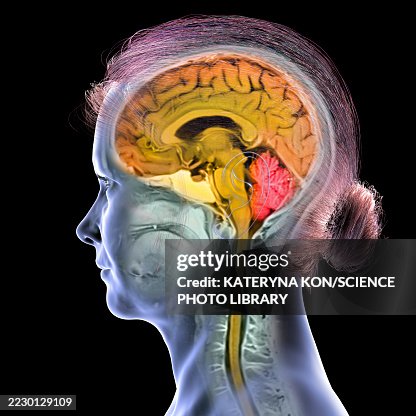 Brain Anatomy Mri Illustration High-Res Vector Graphic - Getty Images