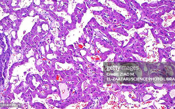 ackd renal cell carcinoma, light micrograph - vacuole stock pictures, royalty-free photos & images