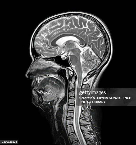 brain anatomy mri, illustration - magnetresonanztomographie stock-grafiken, -clipart, -cartoons und -symbole