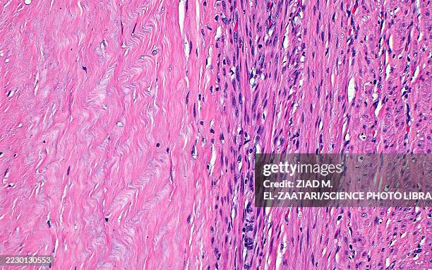 leiomyoma with hyalinisation, light micrograph - fibroids stock pictures, royalty-free photos & images
