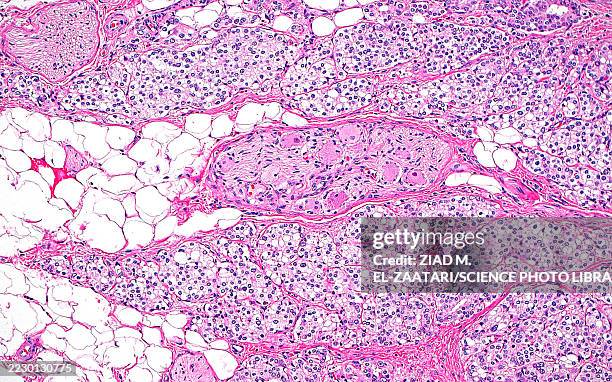 extraprostatic extension, light micrograph - prostate cancer stock pictures, royalty-free photos & images