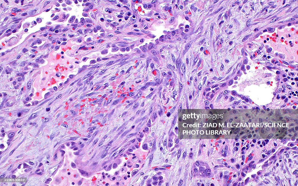 Organising pneumonia, light micrograph