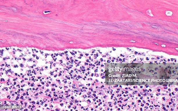 acute osteomyelitis, light micrograph - neutrophil stock pictures, royalty-free photos & images