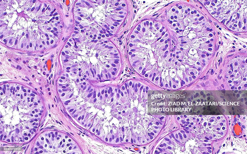 Sertoli cell only syndrome in testis, light micrograph