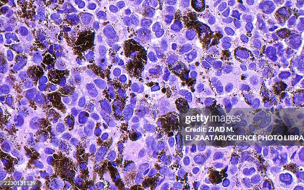 malignant melanoma, light micrograph - melanoma stock pictures, royalty-free photos & images